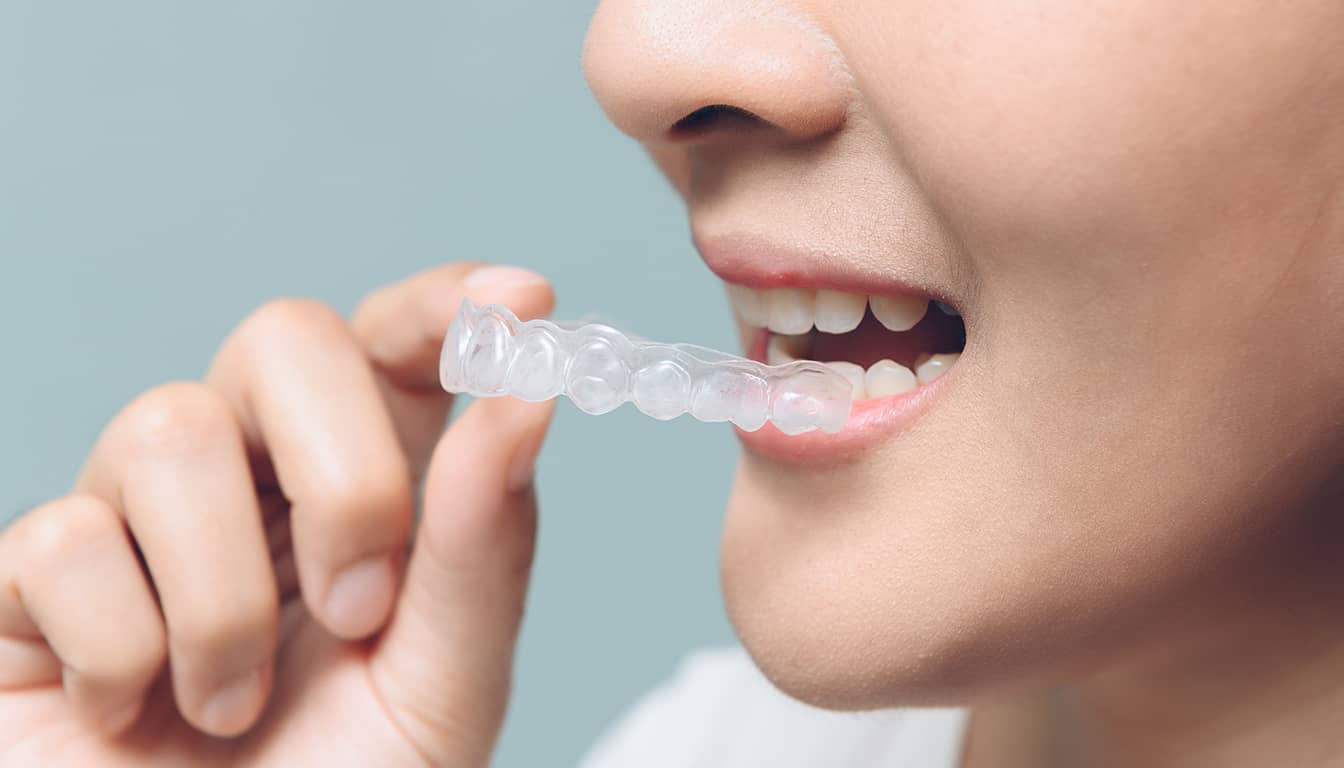 Soins dentaires à Lille : Occlusodontie et gouttières de bruxisme au Cabinet Dentaire Lille Marais.